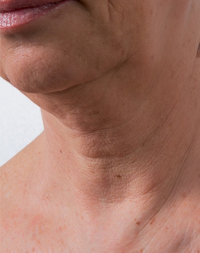 Viscoderm Neck - Before